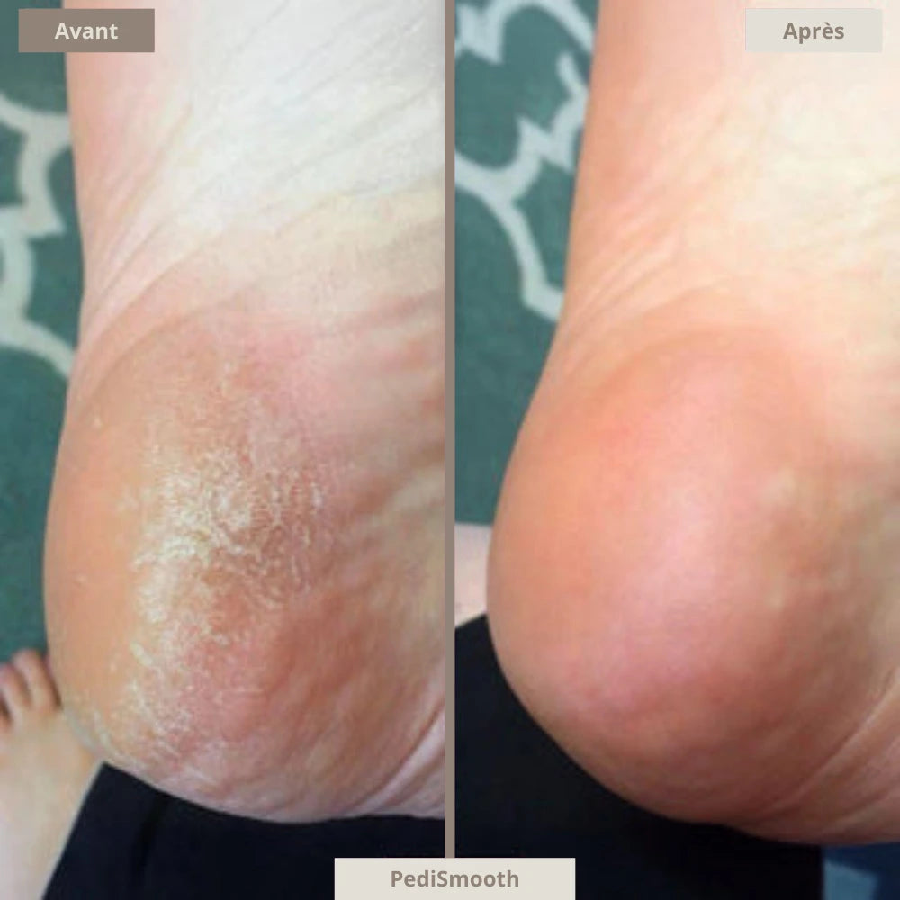 Kit complet - Pedismooth