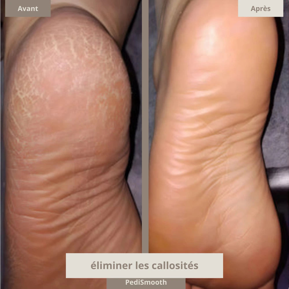 Kit complet - Pedismooth