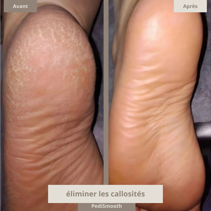 Kit complet - Pedismooth