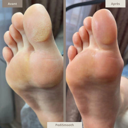 Kit complet - Pedismooth